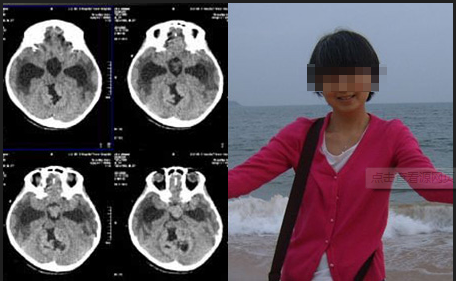 老年癫痫病治疗