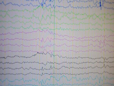 黑龙江中亚医院癫痫精准诊断的重要手段——长程视频脑电图监测的应用